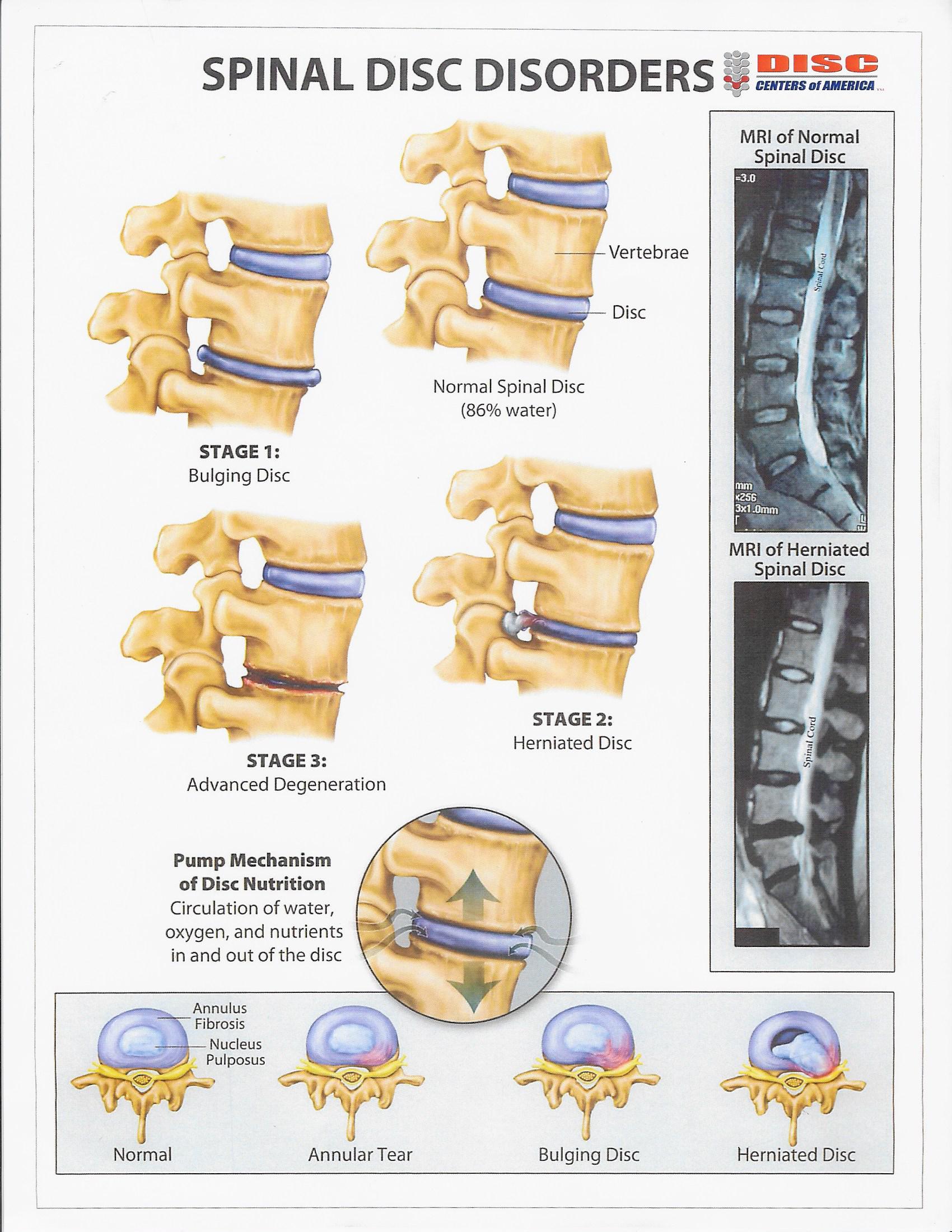 Spinal Disc Disorders